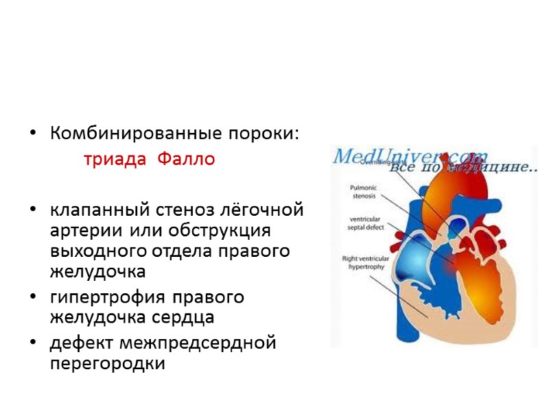 Комбинированные пороки:    триада  Фалло  клапанный стеноз лёгочной артерии или